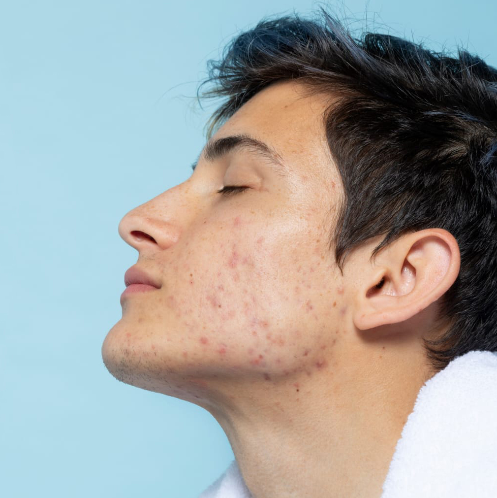 acne acne
